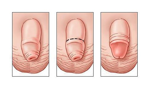Đầu dương vật